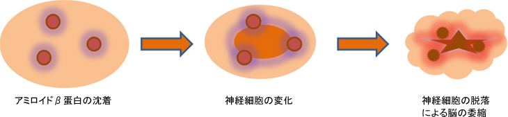 図1. アミロイドβ蛋白(Aβ)の脳内沈着からの脳萎縮